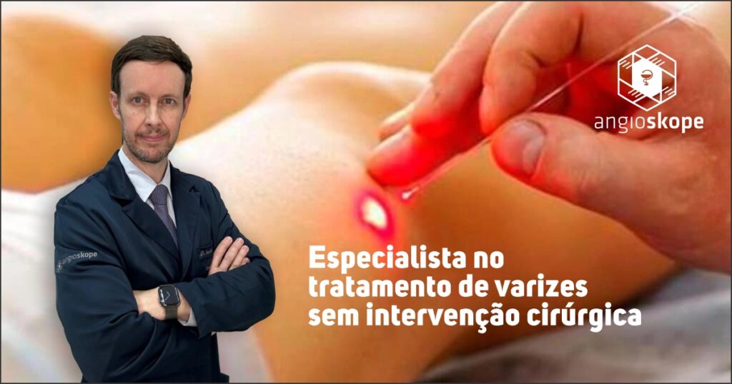 tratamento de varizes